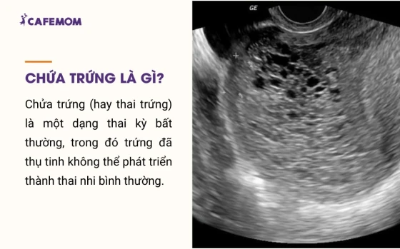 Chửa trứng là gì?